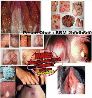 Cara Herbal Menyembuhkan Infeksi Saluran Kencing Dan Keluar Nanah