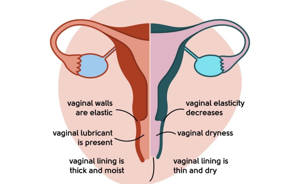 Vaginal Dryness Causes Symptoms And Treatment