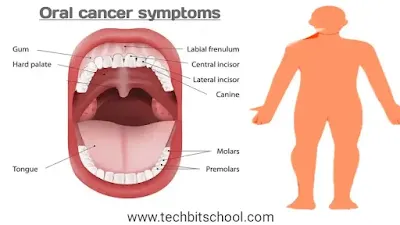 Oral or Mouths Cancer Symptoms