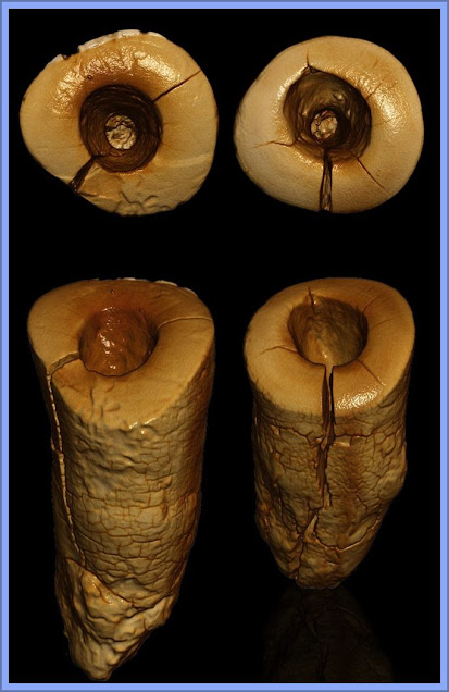 Mesolithic Teeth With Drilled Cavities