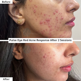 Best Acne Treatment in Lahore