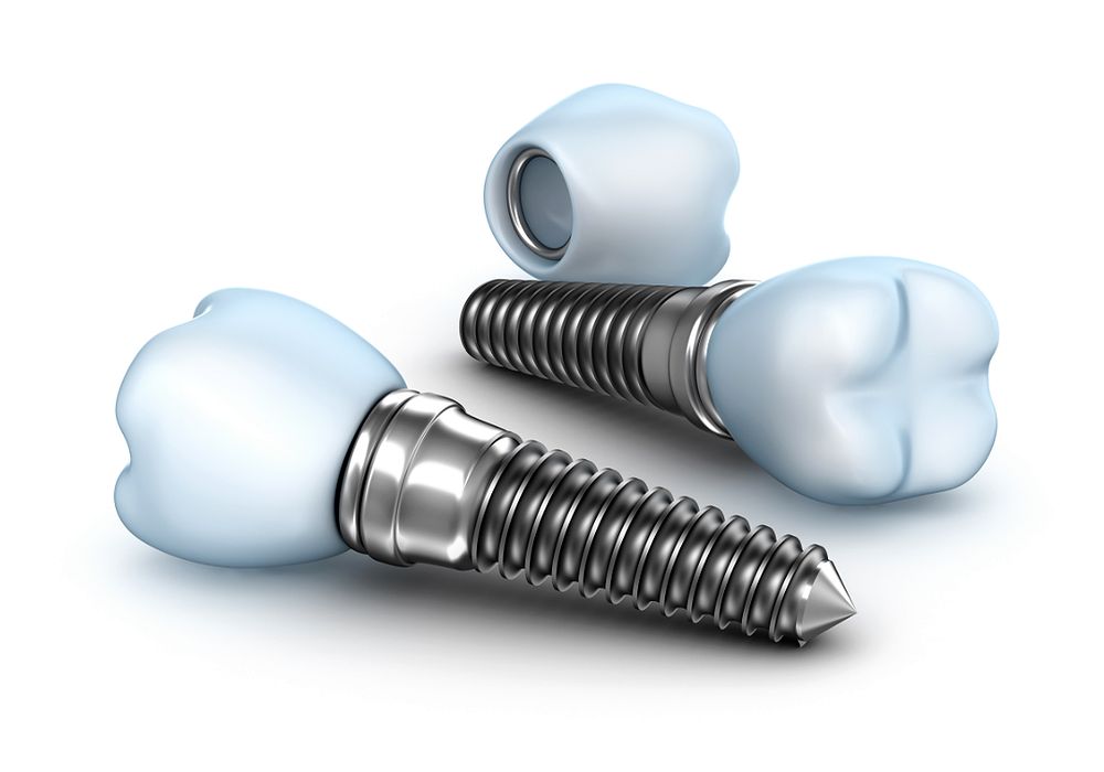 Dental Implants