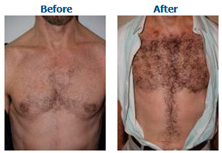 best fue clinic in pakistan http://www.snhc.com.pk/non-surgical-treatment.php