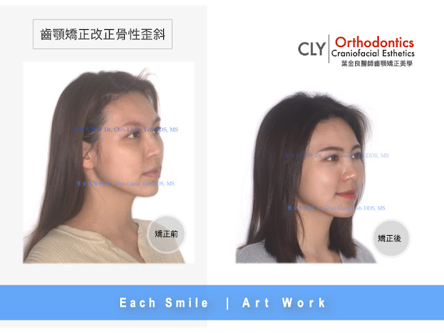 非正顎手術方法解決骨性歪斜  Skeletal Asymme