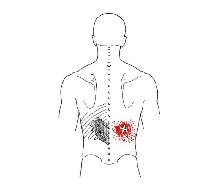 Dolor en el pecho - serrato - posterior inferior - mc spa