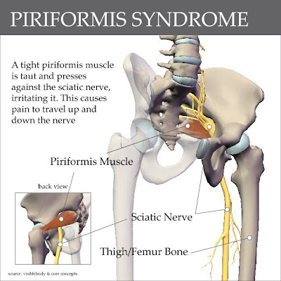 Infinite Lila: Sciatica vs. Piriformis Syndrome