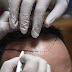 Follicular Unit Hair Transplantation: Strip Harvest Method