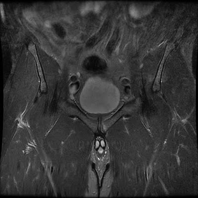 Pubic Stress Reaction with associated Secondary Cleft Sign denoting 