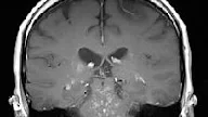 Clippers-Syndrom Mrt : guillain-barre syndrome and tics - Ein kribbeln im kopf kann in seltenen fällen auf das diagnose:
