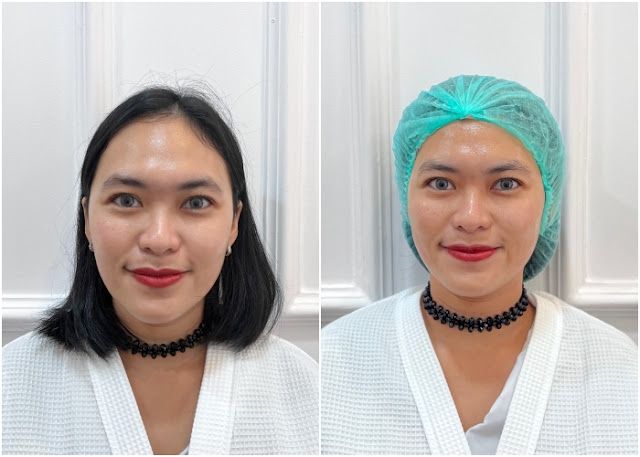 review treatment di Lajolie Aesthetic Jogja