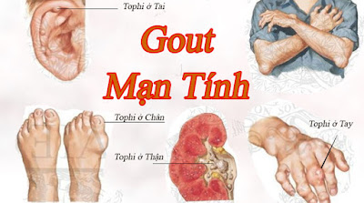 kiến thức bệnh gout