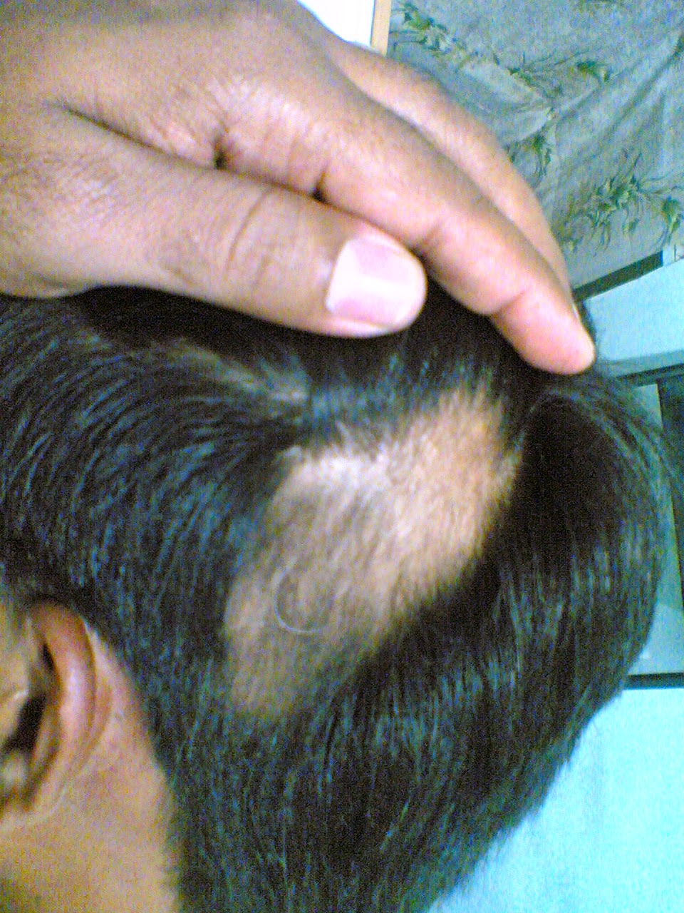  Specialist doctor for alopecial areata dr.sendhil kumar