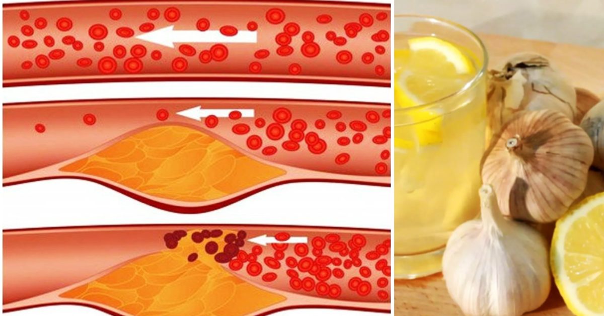 Unclog Your Arteries, Prevent Heart Disease Using This Traditional Lemon Recipe