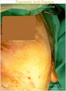 zygomatic arch anatomy, zygomatic arch fracture, titanium plate stabilization, zygomaticomaxillary complex fracture, open reduction and internal fixation, facial trauma, zygomatic fracture treatment, masseter muscle, rigid fixation, biocompatibility, comminuted fracture,