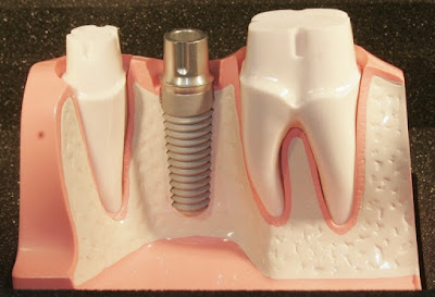 Phương pháp trồng răng giả là gì?