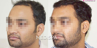 hair transplant in delhi