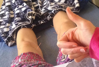 Acupuncture for circulation problems and raynaud's disease