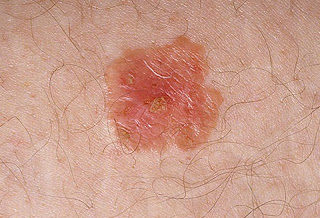 basal cell skin cancer pictures