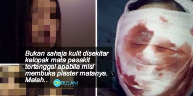 Serem, Gara-gara Pakai Kosmetik Bermerkuri Mata Wanita Ini 