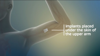 Probuphine implant