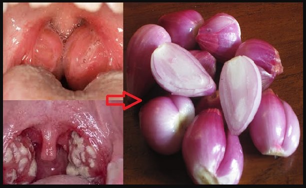 Sungguh Manjur !! Tak Perlu Operasi, Hancurkan Radang Amandel Dengan Rebusan Bawang Merah. Begini Caranya..