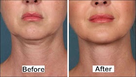 5 Simple Ways To Tighten Your Neck Skin