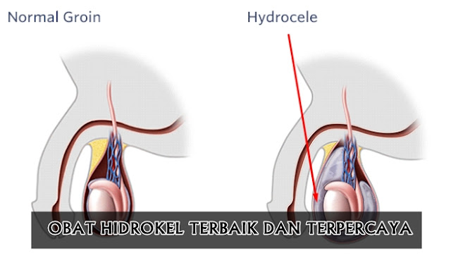 Cara Mengobati Buah Zakar Besar Sebelah Secara Cepat