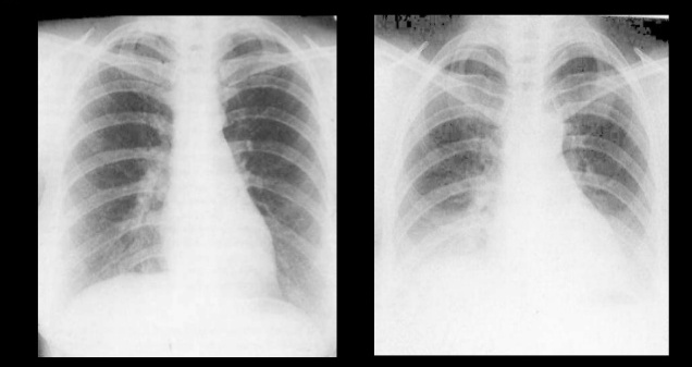 chest xray inspiratory vs expiratory