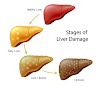 Liver cirrohosis