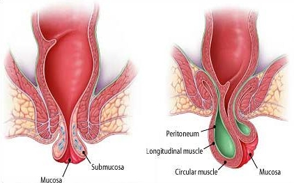 Benjolan Pada Anus Saat Hamil