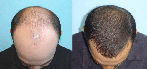 hair transplant in bangalore