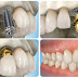 Những lưu ý khi lựa chọn địa chỉ trồng răng implant