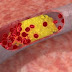 How LDL – the ‘bad boy’ of cholesterol – can kill you!