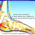 Tarsal tunnel syndrome