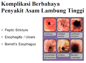 https://mustahabbah.blogspot.com/2017/08/ciri-ciri-asam-lambung-yang-parah.html