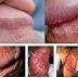 Obat Ampuh Khusus Penyakit Kutil Kelamin thumbnail