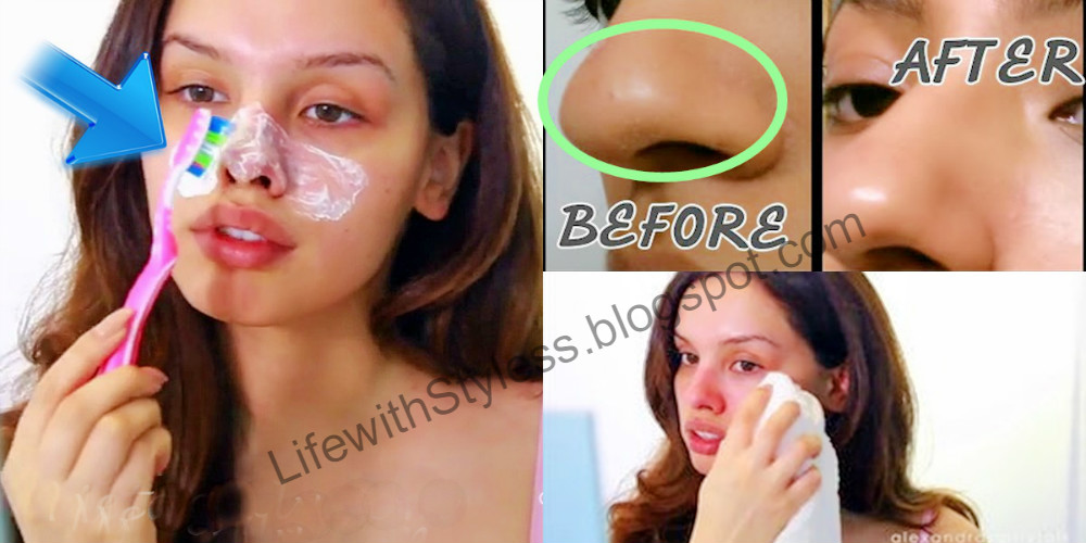 Remove Blackheads with ONE TOOL In Just 5 MINUTES