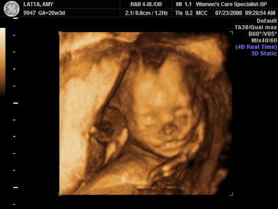 3d ultrasound pictures at 12 weeks. images 3d ultrasound 20 weeks