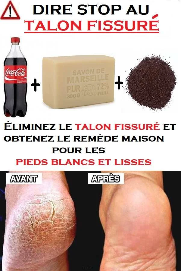 Éliminez le talon fissuré et obtenez le remède maison pour les pieds blancs et lisses