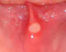 Oral Ulcer