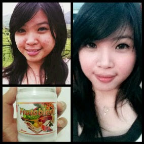 jual obat jerawat badan Palembang