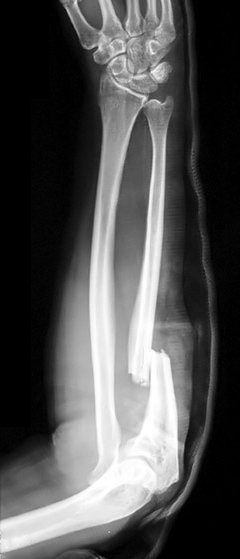 arm fracture causes symptoms and treatment