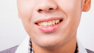 Using Tooth Whitening Methods The Right Way