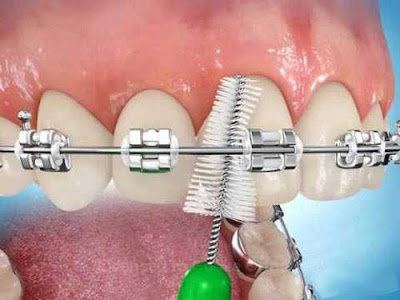 Bàn chải kẻ răng dành cho bệnh nhân mang mắc cài