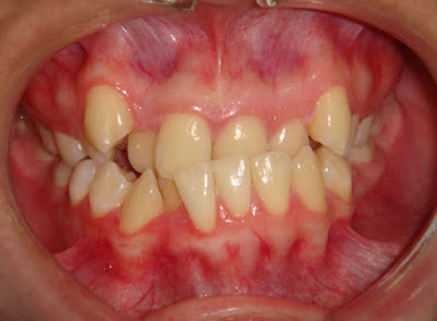 Bị hàm móm có niềng răng được không? Giải pháp nào hiệu quả?-1