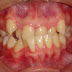 Bị hàm móm có niềng răng được không? Giải pháp nào hiệu quả? 
