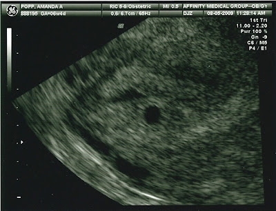 She/he loves to be near the side wall of the gestational sac.