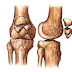 Fractura de la rótula