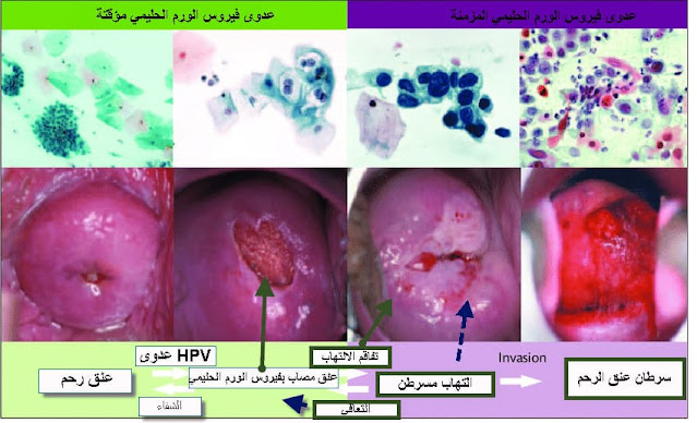 فيروس الورم الحليمي البشري (HPV) وكيف يسبب سرطان عنق الرحم