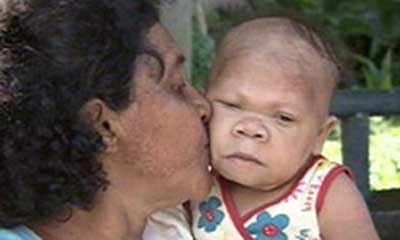 Umur Maria Audete Do Nascimento Sudah 30 Tahun, Tapi Tubuh Dan Tingkahnya Masih Seperti Bayi 9 Bulan [ www.BlogApaAja.com ]